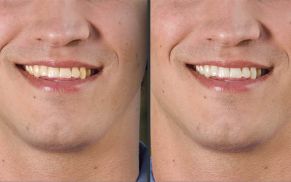 Strahlend weiße Zähne erzeugen – mit Photoshop geht es ganz einfach